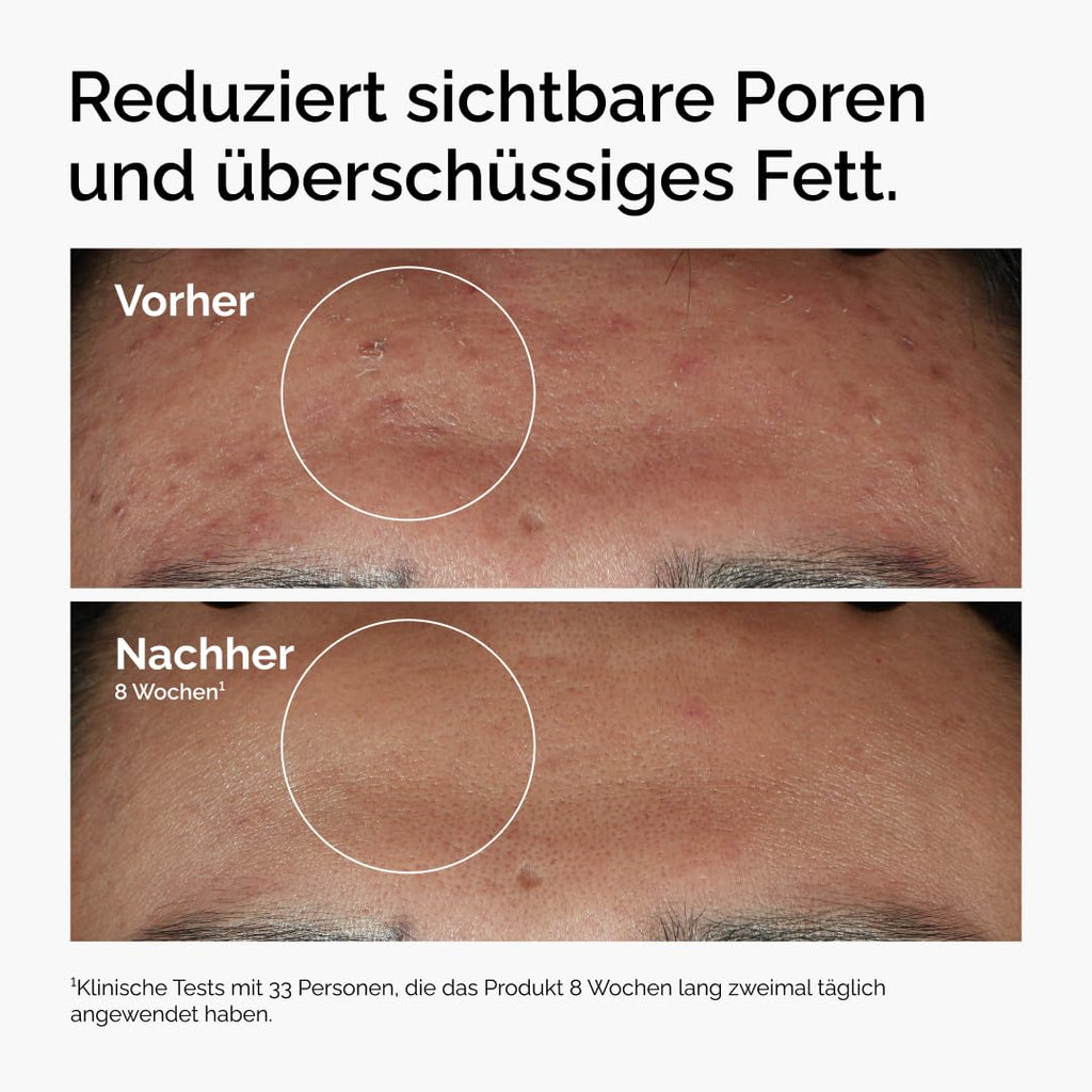 The Ordinary Niacinamid 10% + Zink 1% Serum