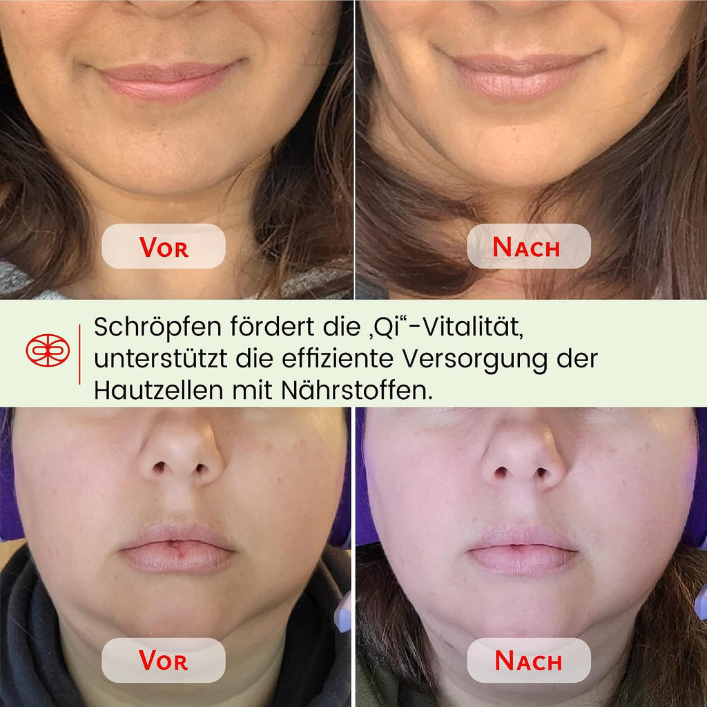 Rena Chris Gesichts-Schroepfset Gua Sha Rosenquarz Silikon Gesichtspflege Rosa