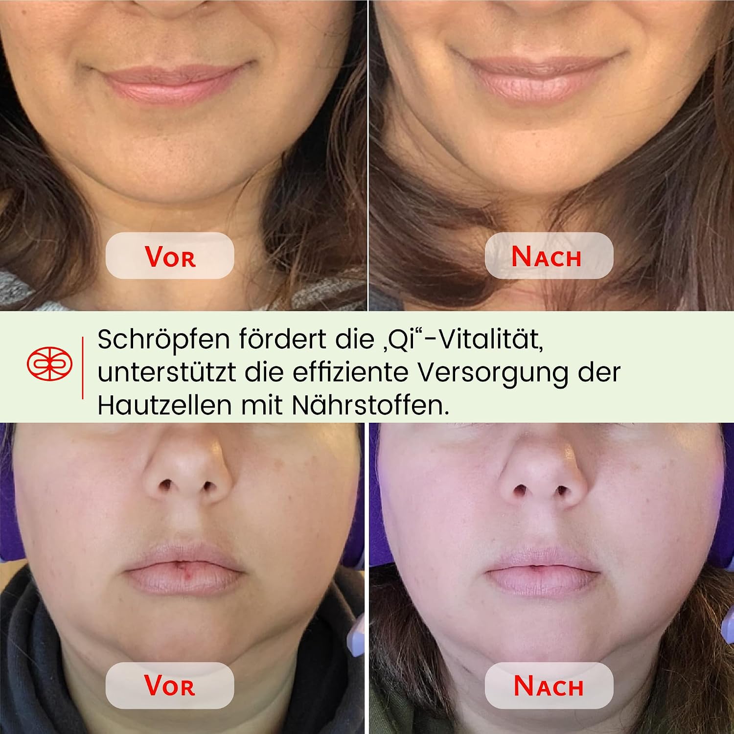 Rena Chris Gesichts-Schroepfset Gua Sha Rosenquarz Silikon Gesichtspflege Rosa