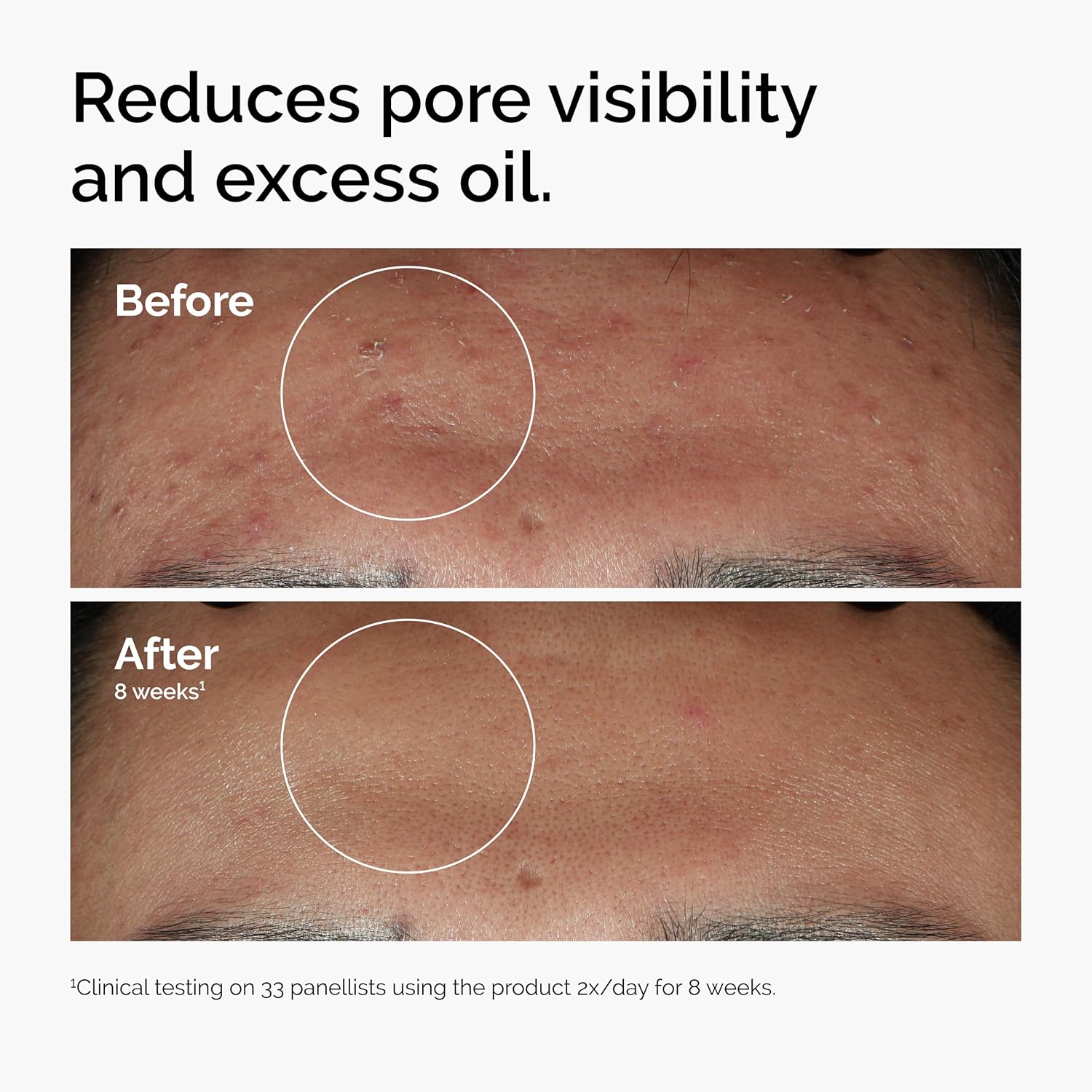 The Ordinary Niacinamid 10% + Zink 1% Serum